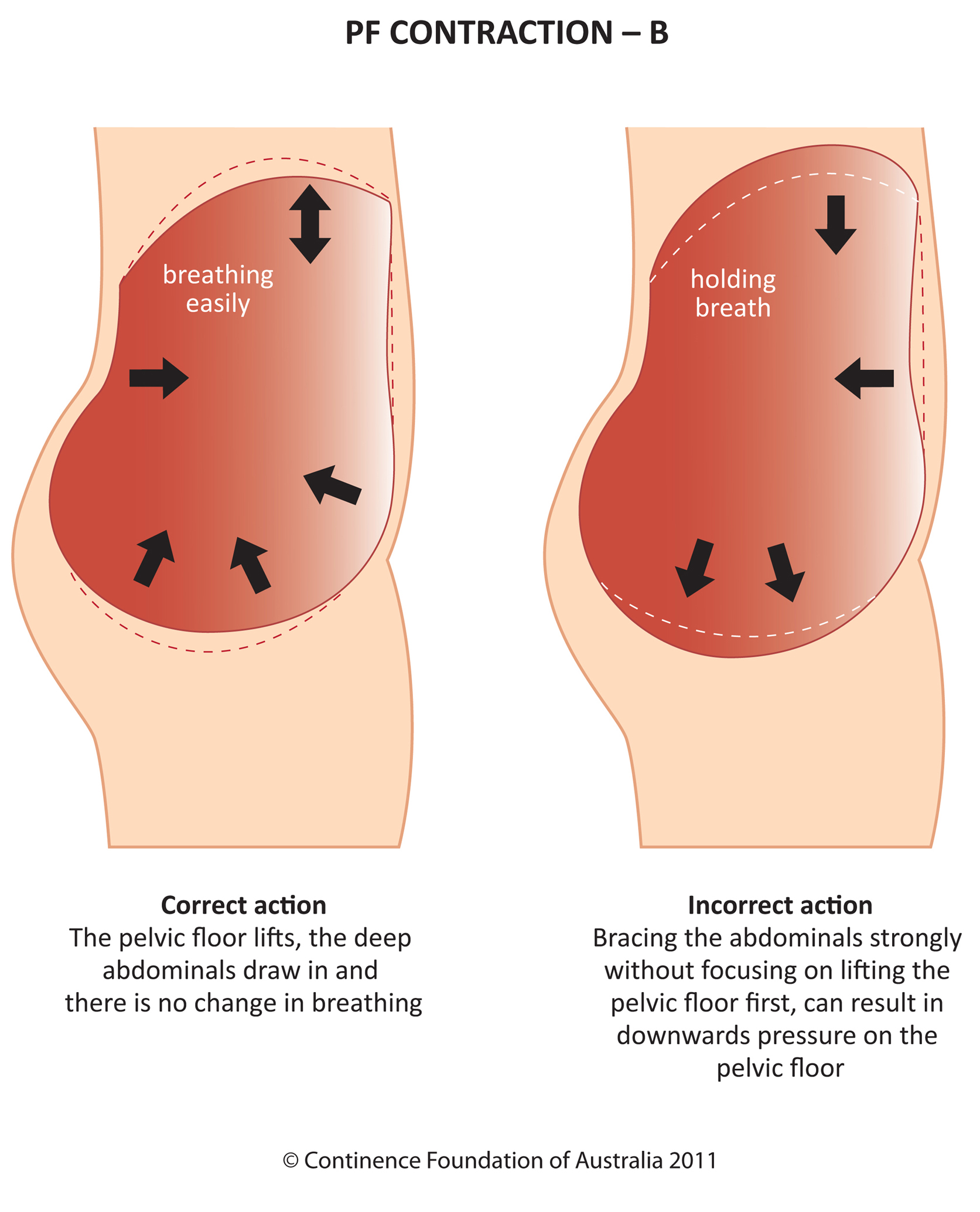 PFM-contraction-B.jpg